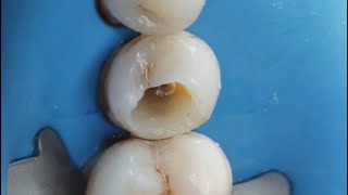 Demonstration of PreEndodontic Build up [upl. by Nagyam484]