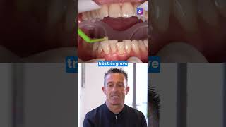 Orthodontie lingual et vestibulaire  collage en technique mixte 🦷 [upl. by Mure]