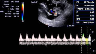 Ecografía Doppler Arteria Umbilical  ECOMEDIC [upl. by Oirromed]