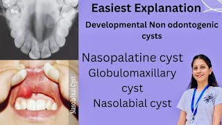 Developmental Non Odontogenic cysts Oral Pathology BDS Nasopalatine Globulomaxillary Nasolabial [upl. by Artair]