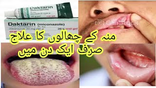 daktarin oral gel how to use miconazole gel oral thrush treatment [upl. by Wolfe614]