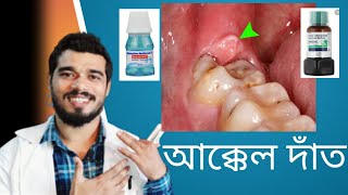 আক্কেল দাঁত নিয়ে সকল সমস্যার সমাধান  How to prevent Wisdom Teeth problem [upl. by Shulock]