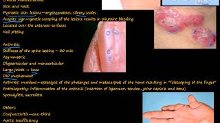 99P Psoriatic Arthritis quotpencil in cupquot deformity [upl. by Rotce469]