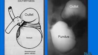 Gastric Volvulus in a Newborn [upl. by Talanian]