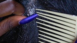 ASMR Scalp Scratching amp NITPICKING dried flakes  ALLZOOMED  no talking [upl. by Ymas503]