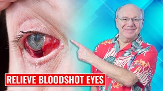 Relieve Bloodshot Eyes [upl. by Uos]