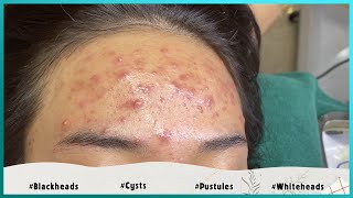 Big Cystic Acne Blackheads Extraction Blackheads amp Milia Whiteheads Removal Pimple Popping [upl. by Phira]