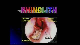 RHINOLITH [upl. by Banks]