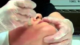 Dermapen Micro Needling Treatment [upl. by Ayikur]