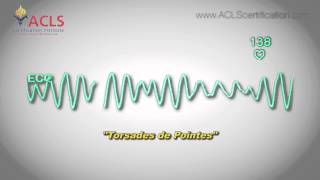 Torsades de Pointes by ACLS Certification Institute [upl. by Mirna]