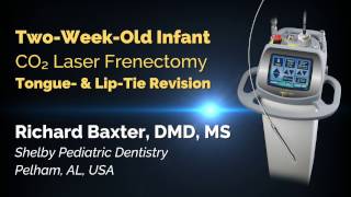 Infant CO2 Laser Frenectomy  Tongue amp LipTie Release  Richard Baxter DMD [upl. by Alitta393]