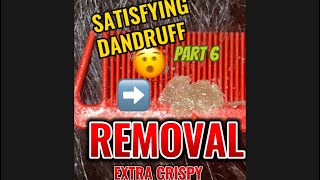 SATISFYING DANDRUFF REMOVAL Part 6 [upl. by Eniamret]