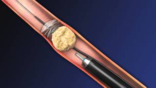 CoAx 10mm Stone Control Catheter from Accordion Medical [upl. by Ogirdor]