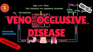 VENOOCCLUSIVE DISEASE Hemodynamics Mechanism of clinical symptoms [upl. by Aikem665]