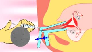 Intrauterine insemination IUI videoflv about infertility and ivf treatment [upl. by Eibloc]