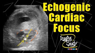 Echogenic Focus EIF Definition Causes Treatment [upl. by Uaerraj]