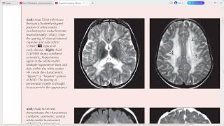 PAEDIATRIC NEURORADIOLOGY DIAGNOSTIC IMAGING [upl. by Wilek523]