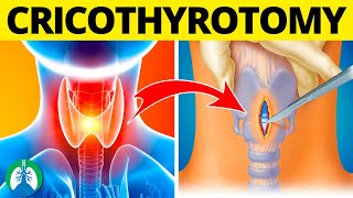 Cricothyrotomy Medical Definition  Quick Explainer Video [upl. by Kcirret]