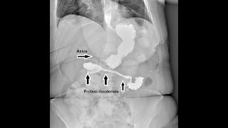 Neoplasia pancreatica con stenosi coledocica e duodenale palliazione endoscopica e EUS [upl. by Millan]