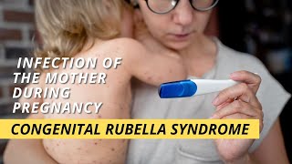 Congenital rubella syndrome CRS [upl. by Middleton]