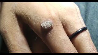 Wart Removal [upl. by Nitin]