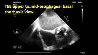 A transesophageal echocardiography TEE quiz [upl. by Enaffit]