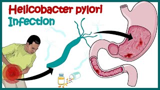 Helicobacter Pylori Infection  Gastric ulcer  Causes Signs and Symptoms Diagnosis and Treatment [upl. by Nashom572]