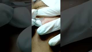 The Blackhead Extractions Breakthrough [upl. by Kletter]