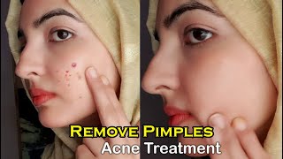 Acne Remedies That Really Work Pimple Treatment at home All You Need to Know [upl. by Ecniuq]