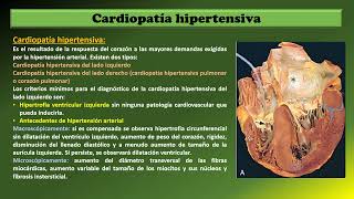 Cardiopatía hipertensiva [upl. by Dolly632]