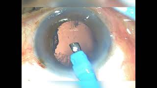 Mature cataract topical phaco surgery [upl. by Idell502]