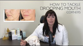 How to Lift Downturned Mouth Corners NonSurgically [upl. by Ldnek]