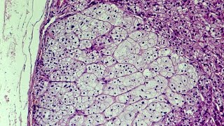 What is Hyperplasia  Pathology mini tutorial [upl. by Thurmann666]