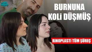 Burun Ameliyatı  1 Hafta ve 1 Ay Sonucu  Burnunun Üzerine Koli Düşmüş [upl. by Bound]