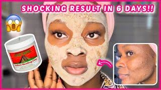 SHOCKING RESULT 😱 6 days of Aztec healing clay mask on my skin  Aztec clay mask for acne [upl. by Azmah]