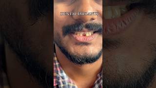 DENTAL IMPLANTS നഷ്ടപ്പെട്ടുപോയ പല്ലുകളുടെ സ്ഥാനത്ത് permanent ആയി പല്ലു വെക്കാംto replace teeth [upl. by Iknarf]