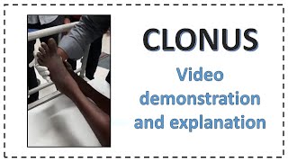 Clonus  Video Demonstration and Full Explanation  In 2 Minutes [upl. by Tiana584]