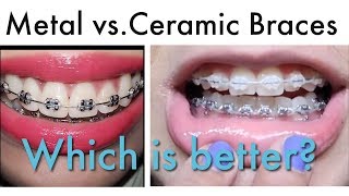 WHICH IS BETER Metal or Ceramic Braces [upl. by Eilrac753]