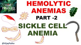 Hemolytic Anemias Part 2 SICKLE CELL ANEMIA Pathology [upl. by Sim]