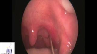 Tonsil Stone Extraction with Laser Cryptolysis [upl. by Siraved258]