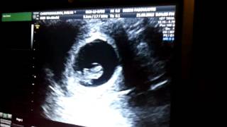 BABY HEARTBEAT  8 WEEKS 3 DAYS PREGNANT [upl. by Stevana]