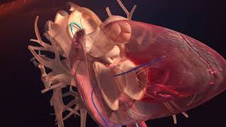 Opération cardiaque en 3D  Cathéter cardiaque [upl. by Redyr]