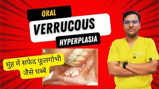 Dr Rudra Mohan  Oral Verrucous Hyperplasia in Simple Terms  मुंह में सफेद फूलगोभी जैसे धब्बे [upl. by Anivlis]