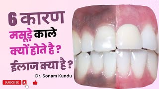 6 Causes of Black Gums Treatment । Precautions। Dr Sonam Kundu [upl. by Bubb]