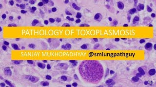 Pathology of toxoplasmosis [upl. by Wilburn517]