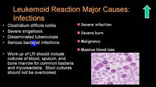 LEUKEMOID REACTION 4TH YR [upl. by Eeram]