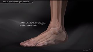 FibuLock® Fibular Nail Surgical Technique [upl. by Sicard]