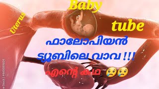 ഫാലോപിയൻ ട്യൂബിലെ വാവMy Tubal Pregnancy Story Malayalam Ectopic Pregnancy Story Malayalam [upl. by Kati]