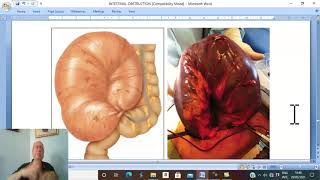 Intestinal disorders in Arabic 9  Volvulus  part 1   by Dr Wahdan [upl. by Ecyoj]