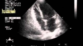 dissecting hematoma of the interventricular septum with biventricular apical small thrombi [upl. by Sharia595]